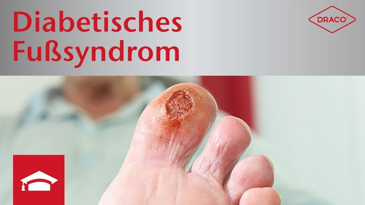 Video: Diabetisches Fußsyndrom, Vorschaubild