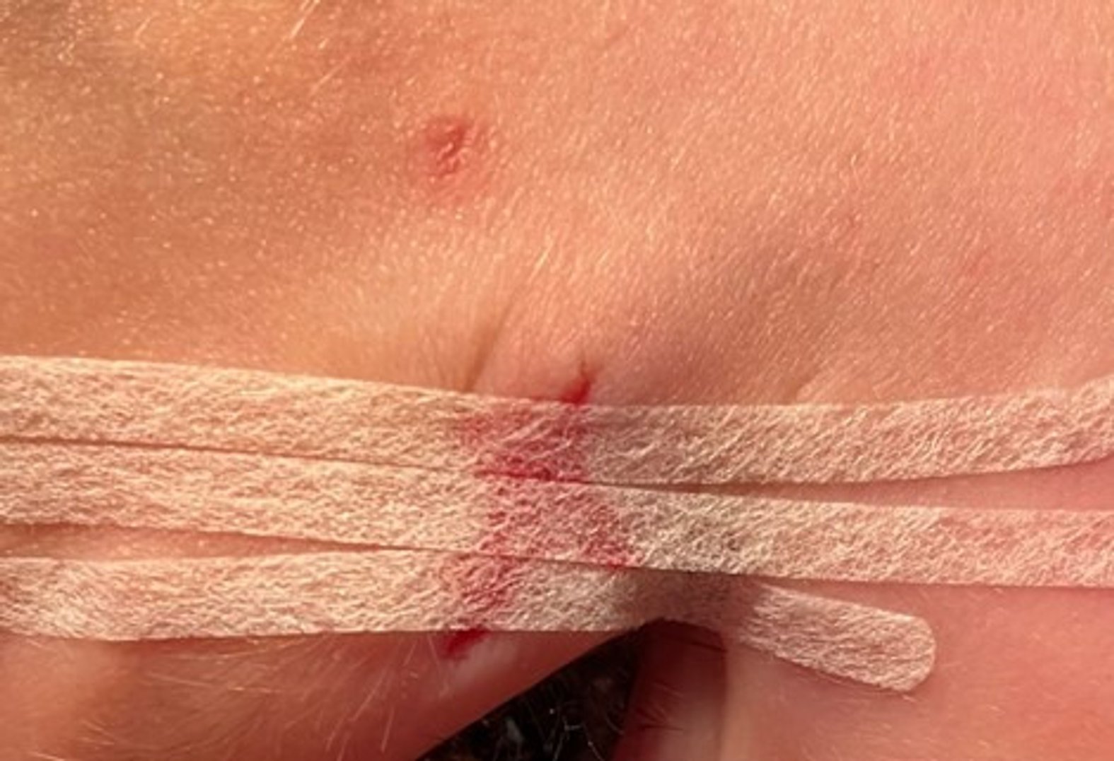 Mit Wundnahtstreifen geschlossene, oberflächliche Platzwunde