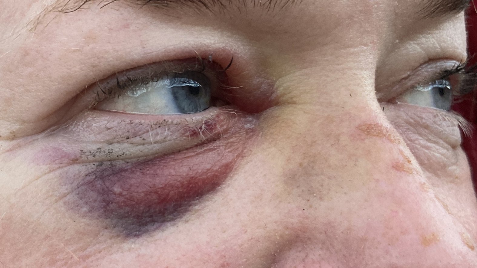 Quetschwunde am Auge, Heilungsverlauf Tag 3