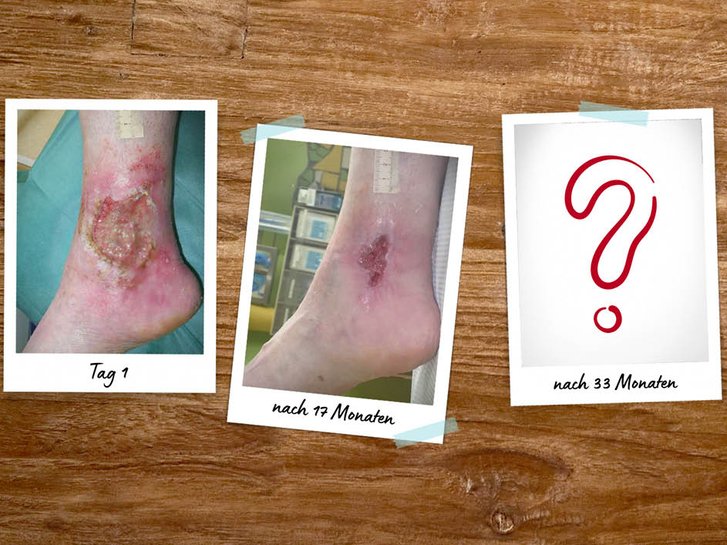 Fallbeispiel Ulcus cruris arteriosum