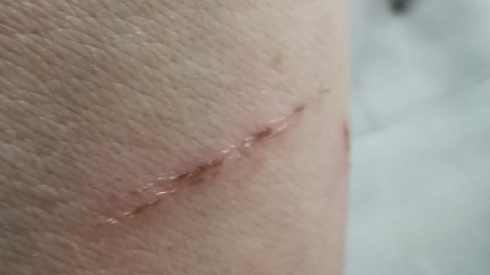 Verschorfte, leichte Kratzwunde