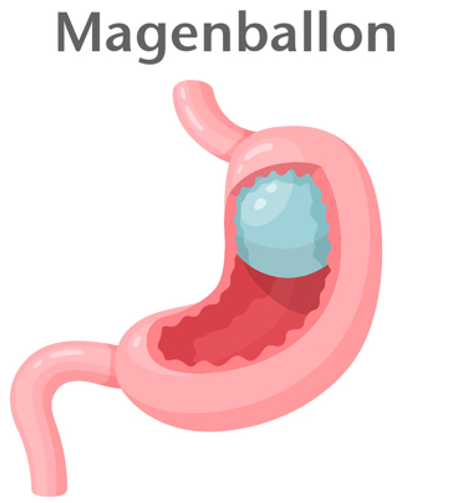 Magenballon, Methode der Adipositaschirurgie (Schema)