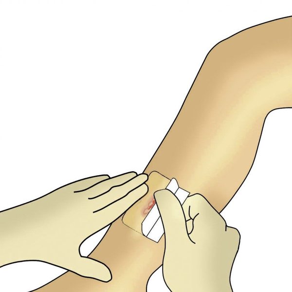 Dracohydroduenn Verbandwechsel Schritt 4