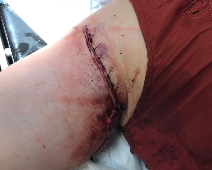 Risswunde unter der Achsel, genäht