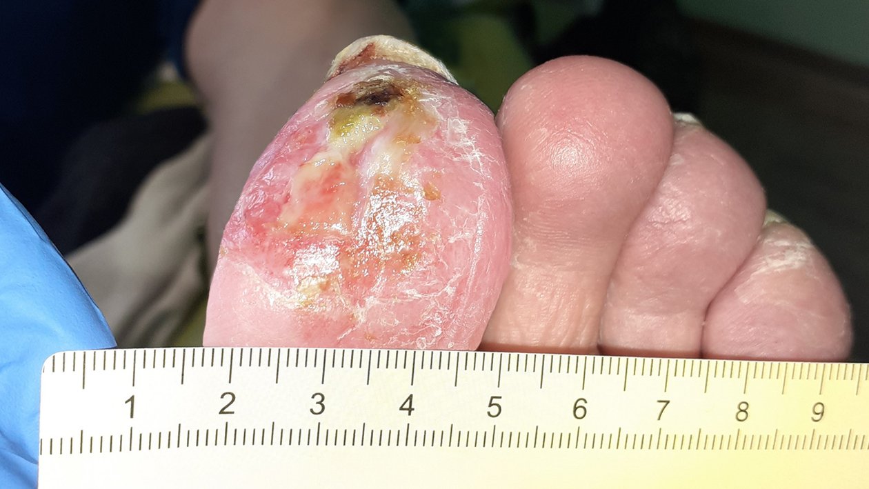 Nekrose am Zeh, Nachher-Bild