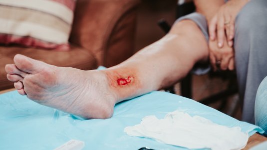 Kurz und kompakt: Die ABCDE-Regel zur Diagnostik chronischer Wunden