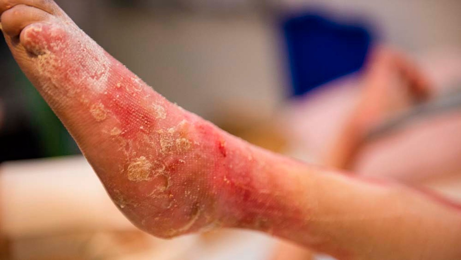 Trockene EB-Wunde am Fuß