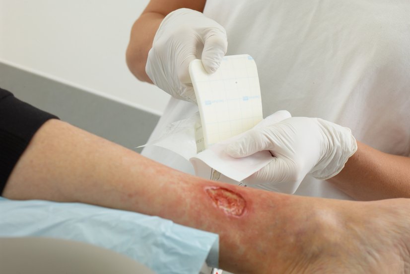 Ulcus cruris Wundversorgung mit DracoFoam infekt