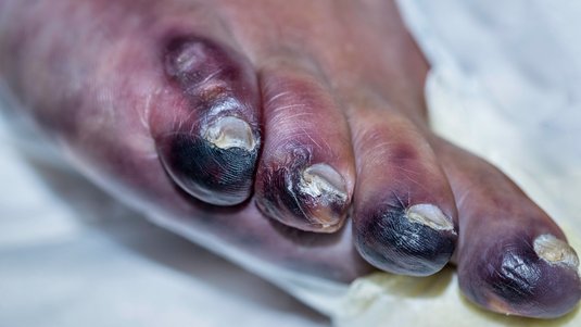 Kurz und kompakt: Gangrän erkennen und therapieren