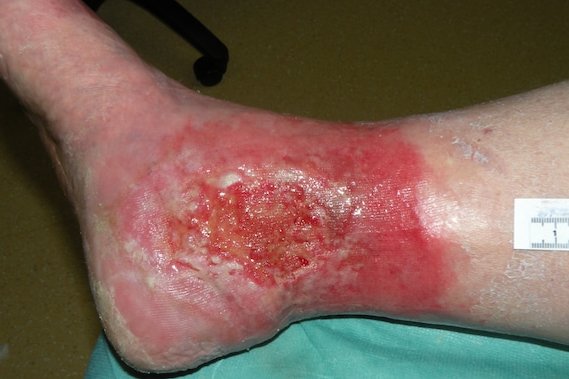 Chronische Wunde am Fußknöchel