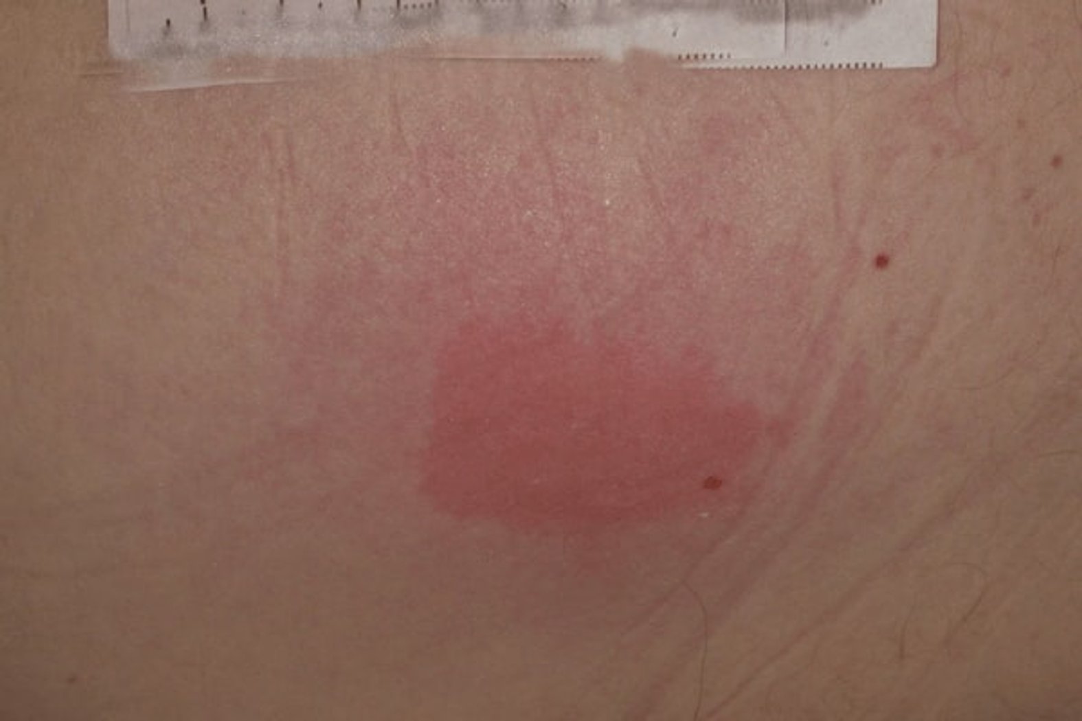 Dekubitus der Kategorie 1