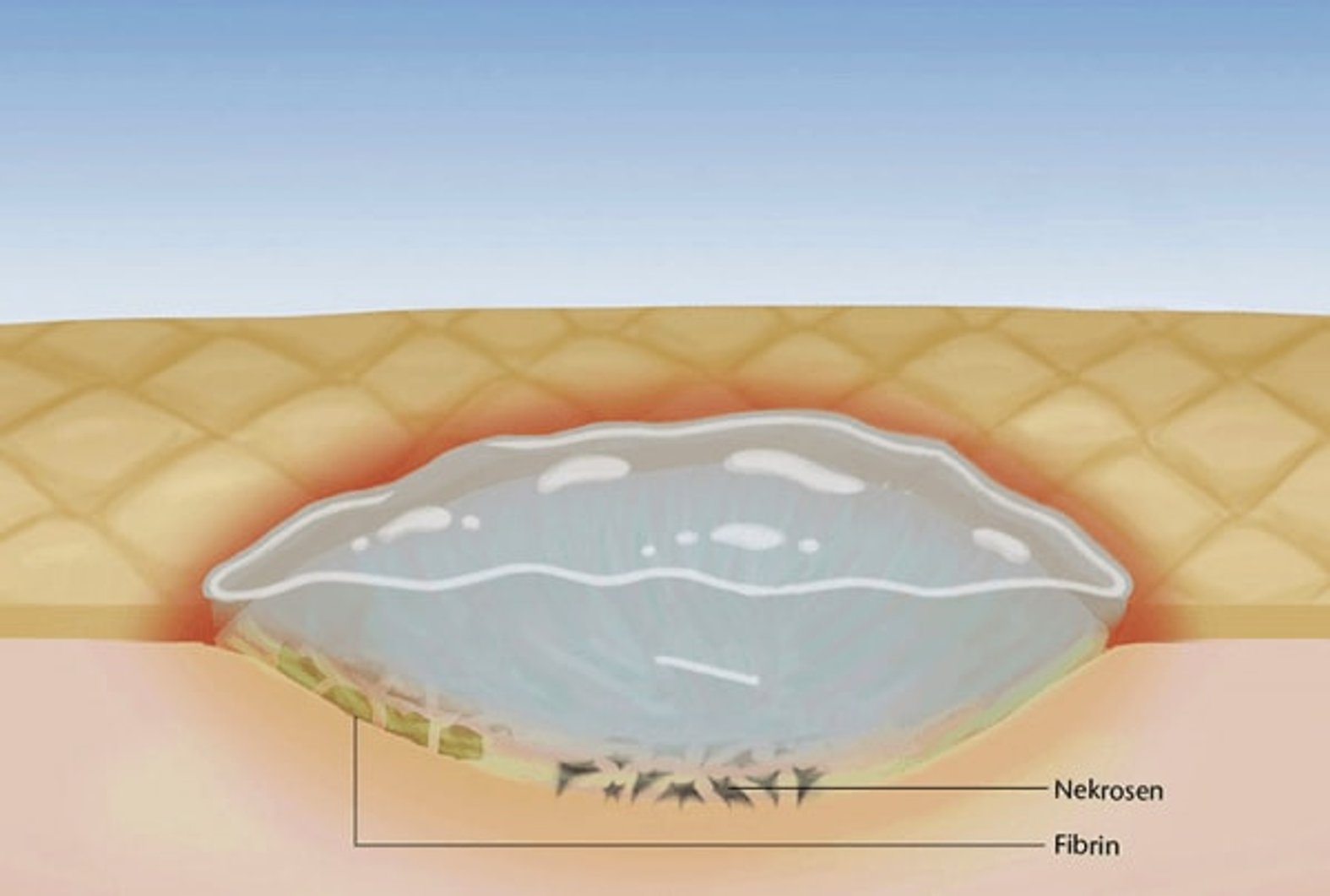 Autolytisches Débridement, schematische Darstellung