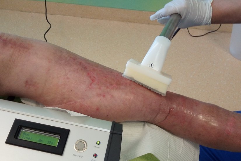 Kaltplasma-Behandlung zur Therapie chronischer Wunden