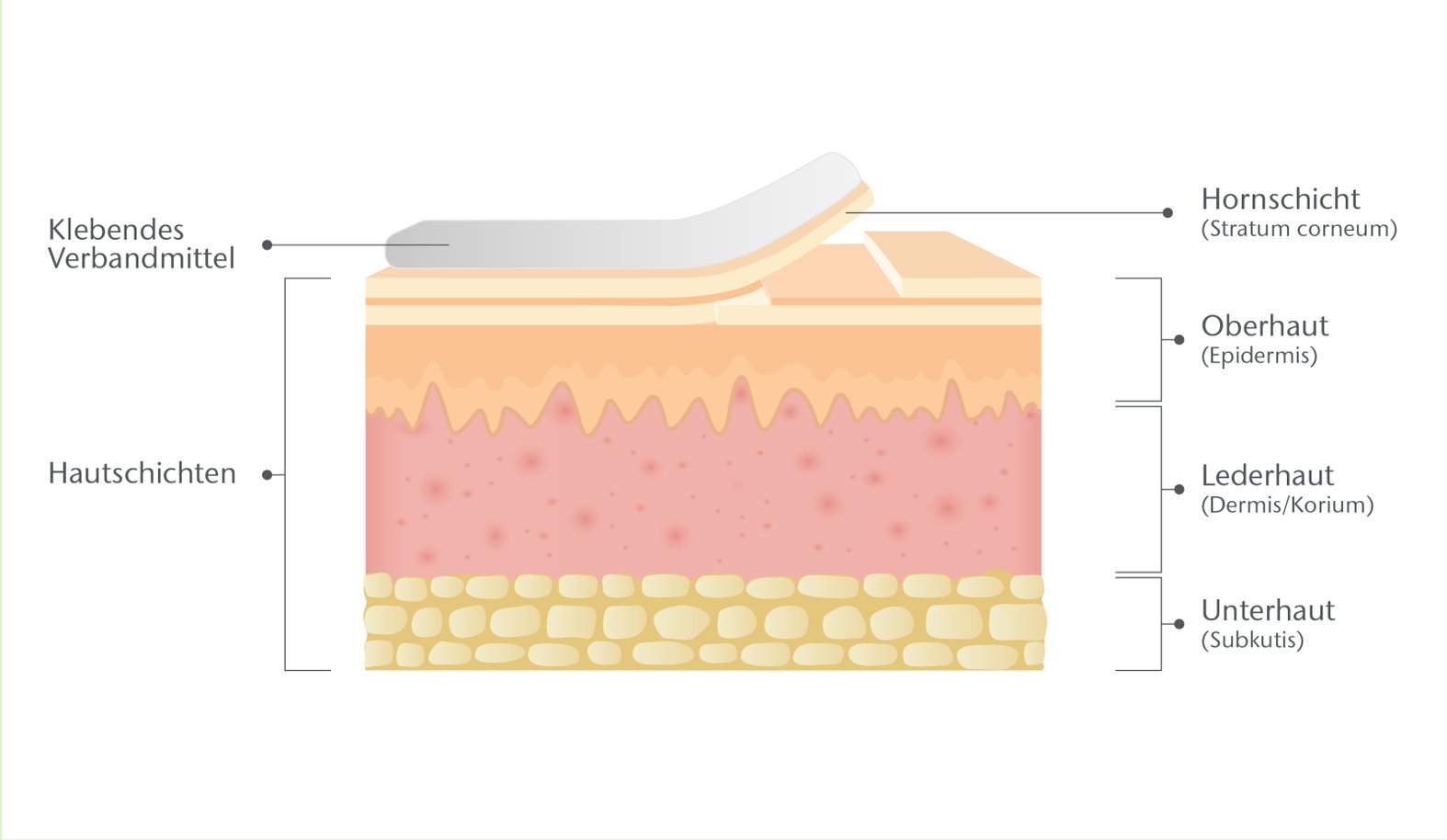 MARSI: Ablösung Stratum Corneum
