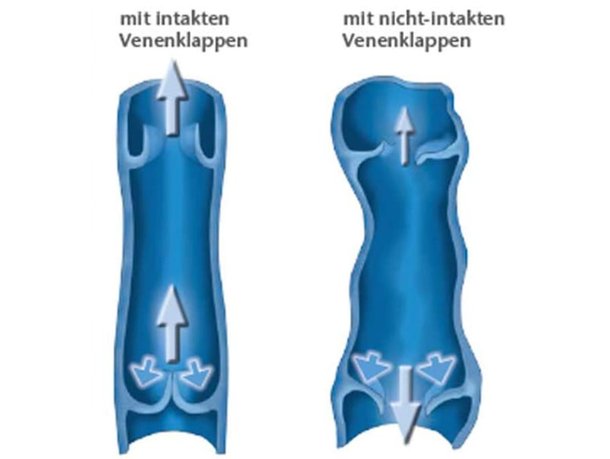 Grafik von zwei Venen-Querschnitten