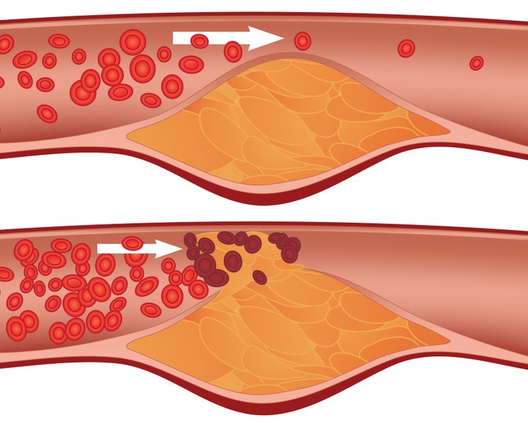 Arteriosklerose