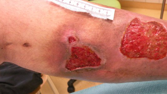 Ulcus cruris: Wissenwertes, Diagnostik und Therapie