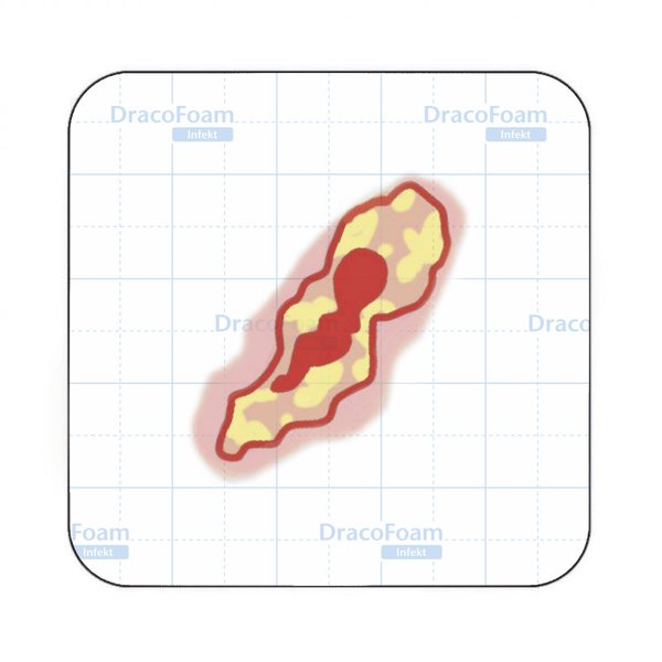 Dracofoam Infekt Verbandwechsel Schritt 4