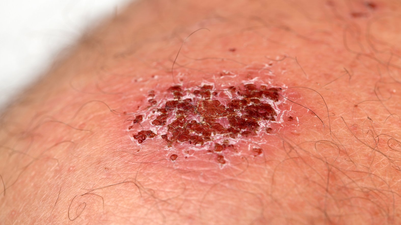 Wundschorf: Wundkruste oder Wundgrind auf einer Schürfwunde