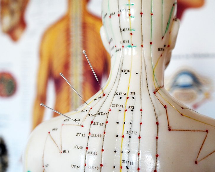 Schmerztherapie, Akupunktur Modell mit Meridianen und Akupunkturnadeln