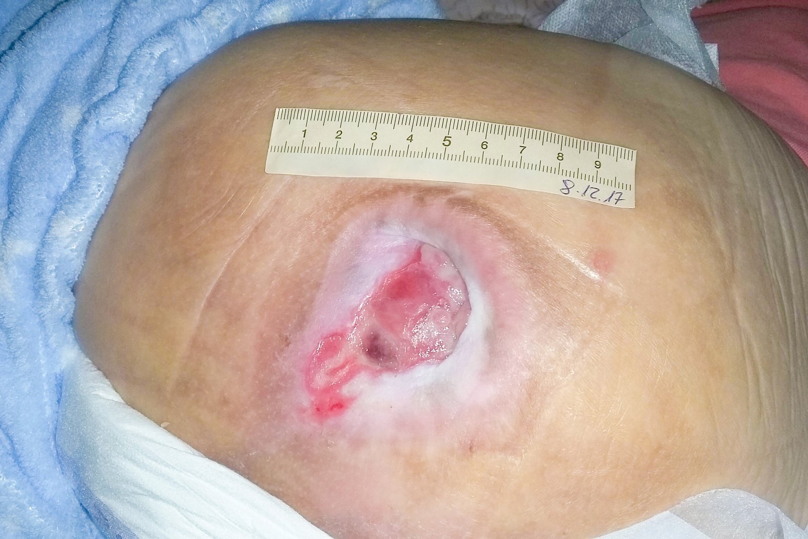 Foto 4: Wundsituation nach 16-wöchiger stationärer Behandlung (Tag 190)