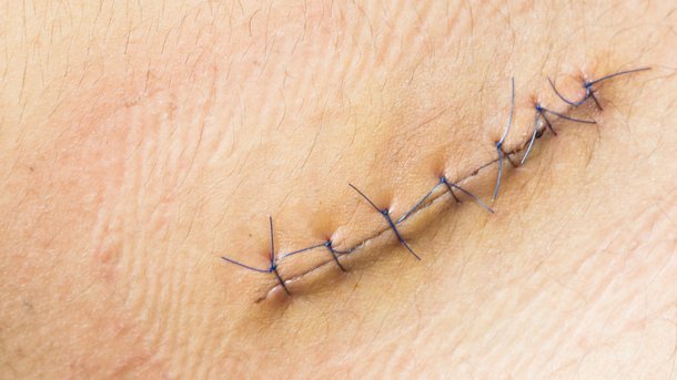 Genähte, primär heilende Wunde