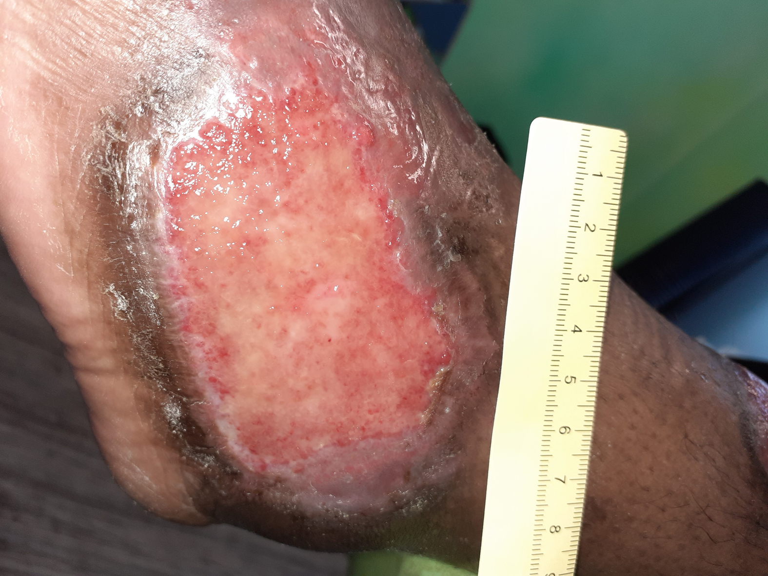 Foto 5: Deutlich verkleinerte Wunde am linken Fuß lateral (Tag 96)