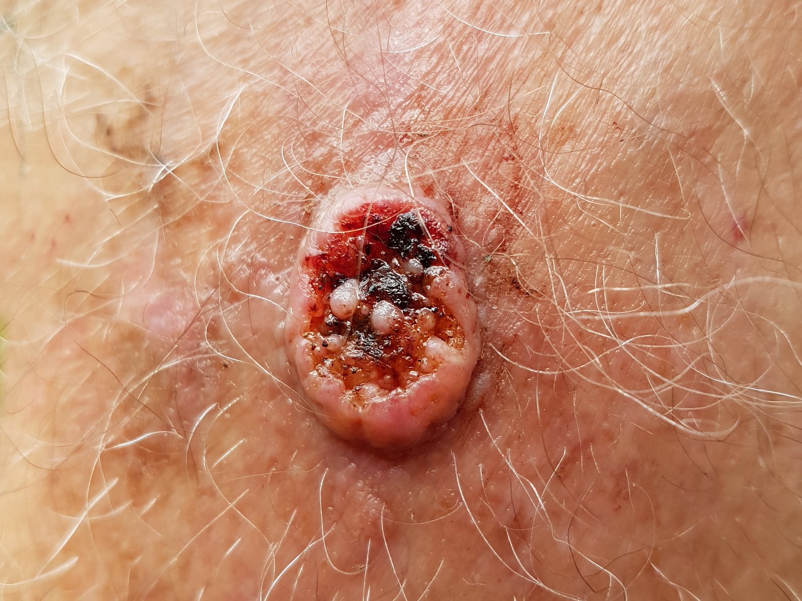 Basalzellkarzinom, Basaliom (veraltet)