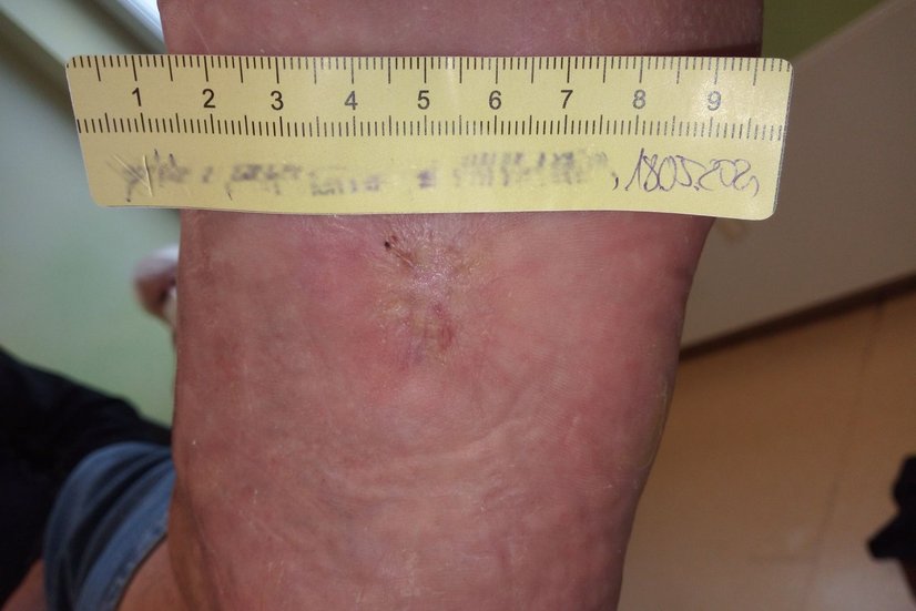 Diabetisches Fußulcus – Wundheilung ist abgeschlossen