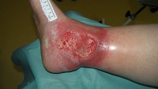 Das M.O.I.S.T.-Konzept zur Lokaltherapie chronischer Wunden