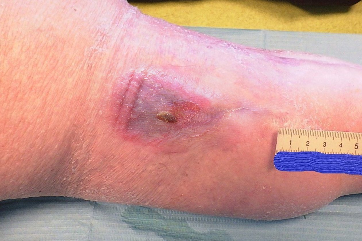 Ulcus cruris venosum, Nachher-Bild