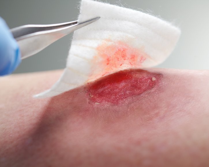 Neues Hydrogel zum Patent angemeldet