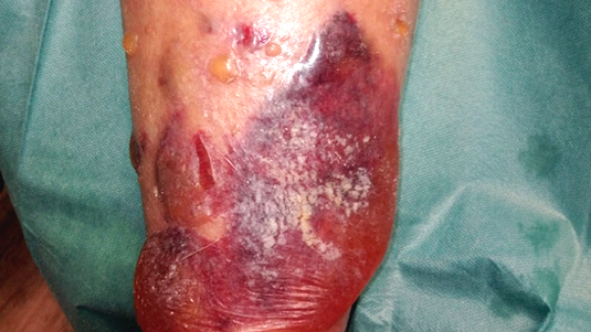 Fallbeispiel: Ulcus cruris venosum nach Trauma