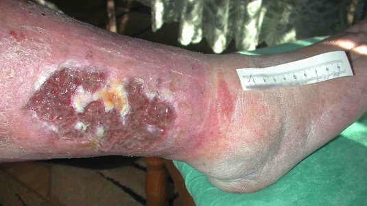 Exsudatmanagement in der Wundversorgung – Beurteilung