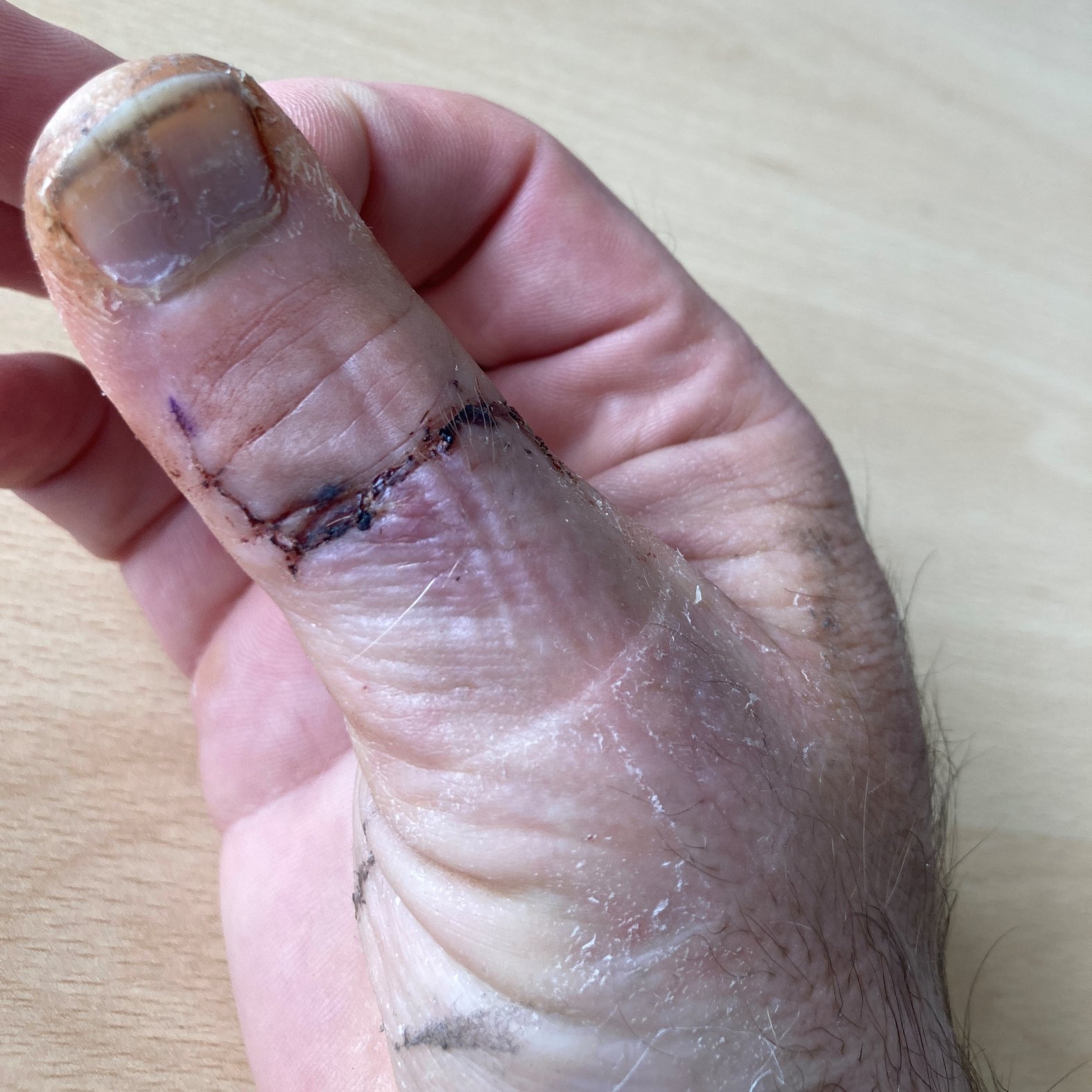 Foto 12: Wundsituation nach 1 Monat