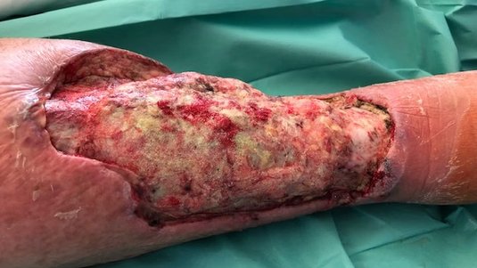 Fallbeispiel: Pyoderma gangraenosum - Große Wunde nach vermeintlich harmloser Verletzung