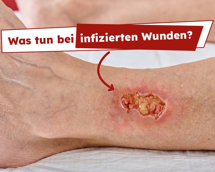 Sommer, Hitze und infizierte Wunden: Neues Online-Seminar