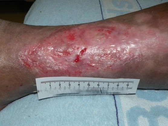 Epithelisierungsphase eines Ulcus Cruris venosum