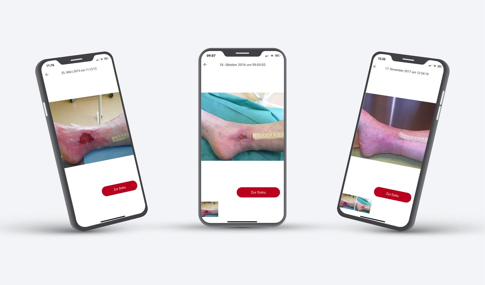 Wunddokumentation: Heilungsverlauf zur Adhärenzförderung einsetzen