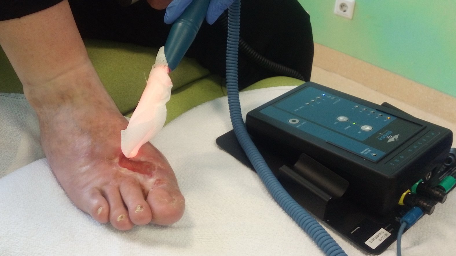 Wundbehandlung mit kaltem Plasma, chronische Fußwunde
