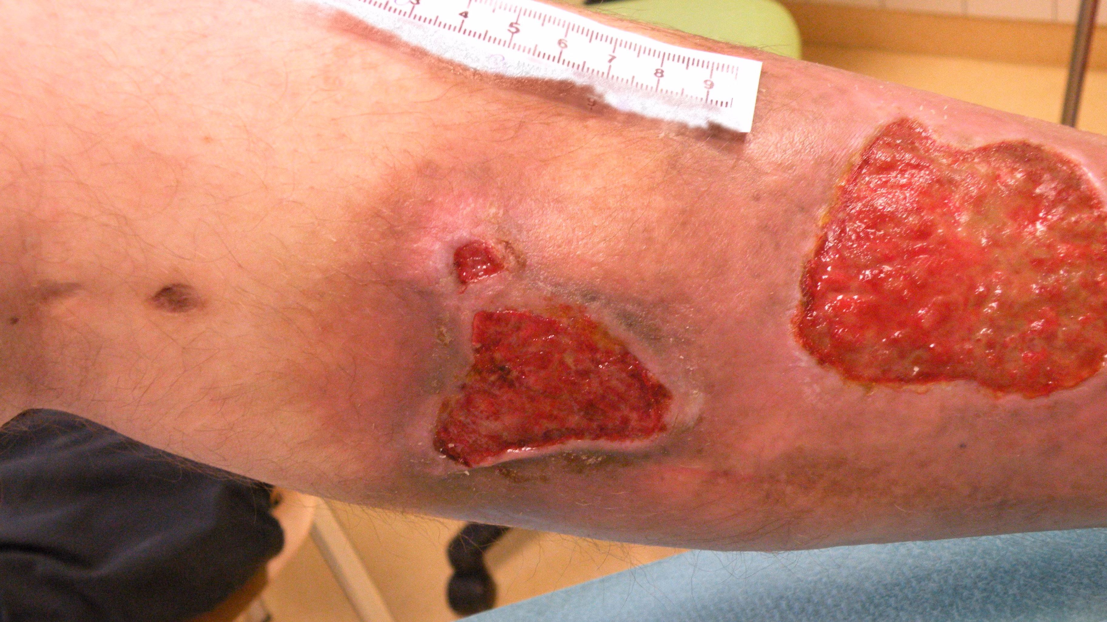 Ulcus cruris: Wissenwertes, Diagnostik und Therapie