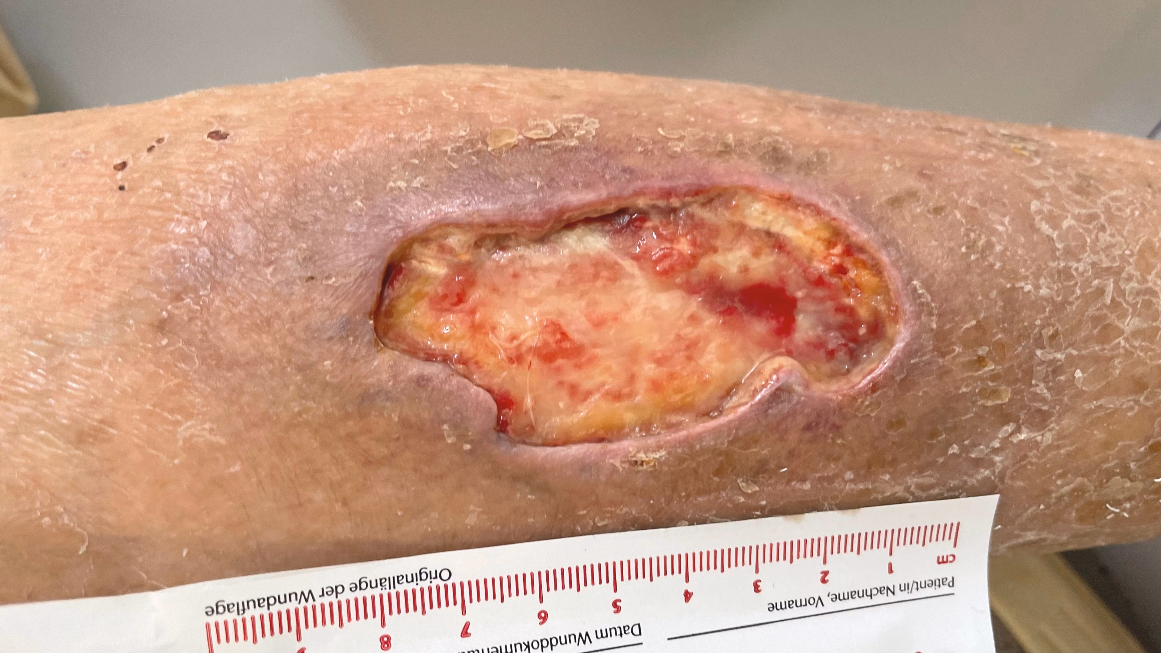 Ulcus cruris venosum und Ulcus cruris arteriosum: Wissen Sie mehr!