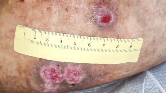 Bauchdeckenulzeration bei Abdominalhernie – Ein Fallbeispiel aus der Praxis