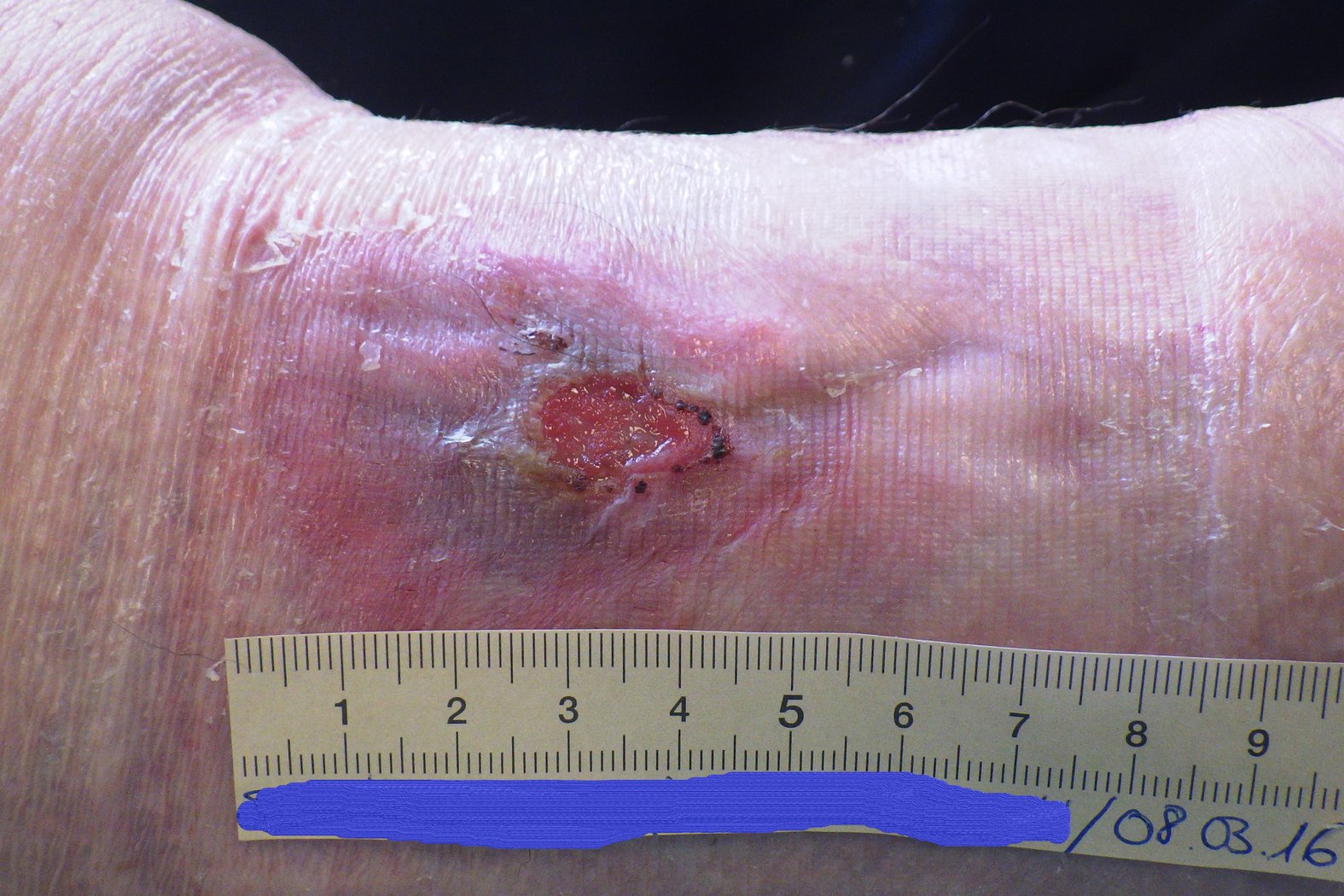 Ulcus cruris venosum, Foto 2