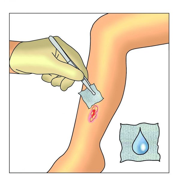 Dracofoam Infekt haft Verbandwechsel Schritt 1