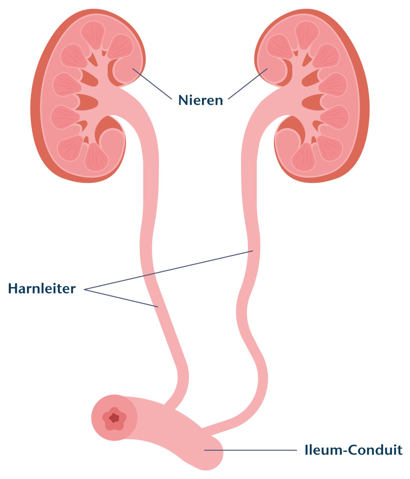 Urostoma: Ileum-Conduit, Schema
