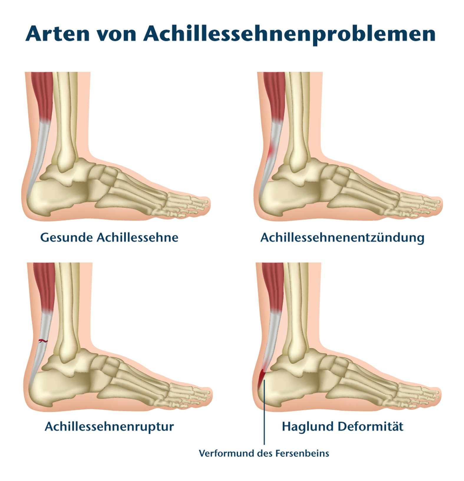 Vier Arten von Achillessehnenproblemen illustriert