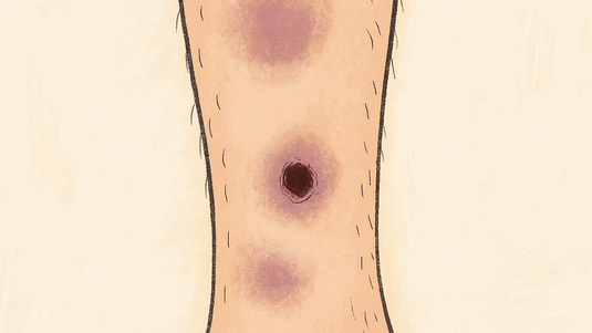 Kurz und kompakt: Das Warnsignal – Calciphylaxie