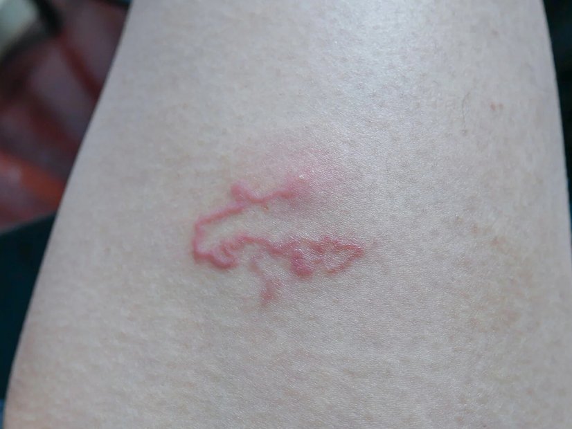 Draco Teaser Reisedermatosen