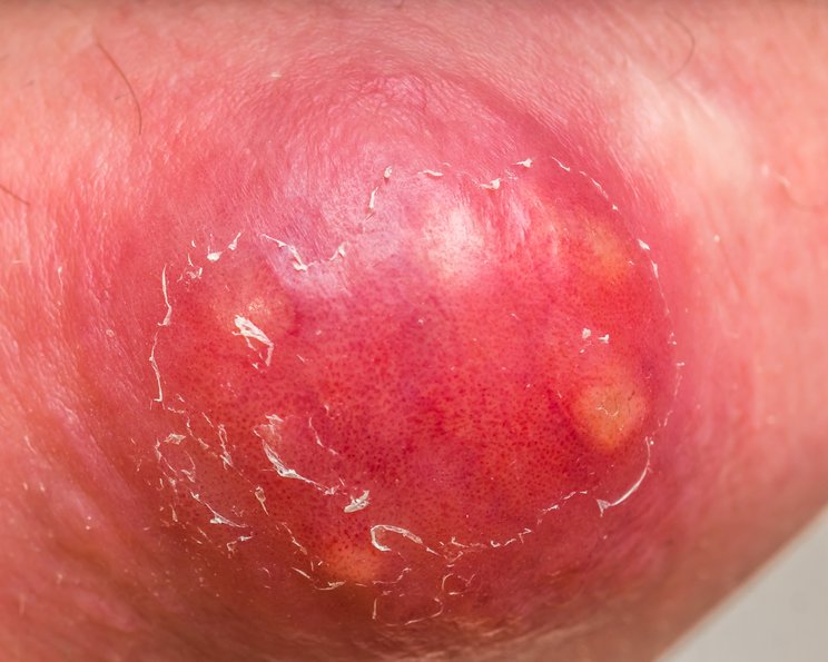 Eiter und eitrige Wunden